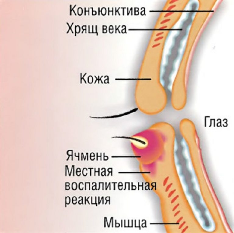 Как избавиться от ячменя быстро. Ячмень обрабатывают настойкой из цветков календулы. Применение сухого тепла.