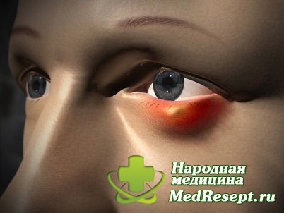 Что делать с ячменем. Лечение ячменя в домашних условиях.