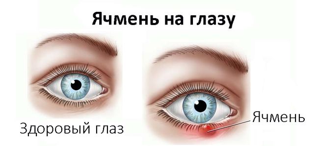 Что делать с ячменем. Лечение ячменя в домашних условиях.